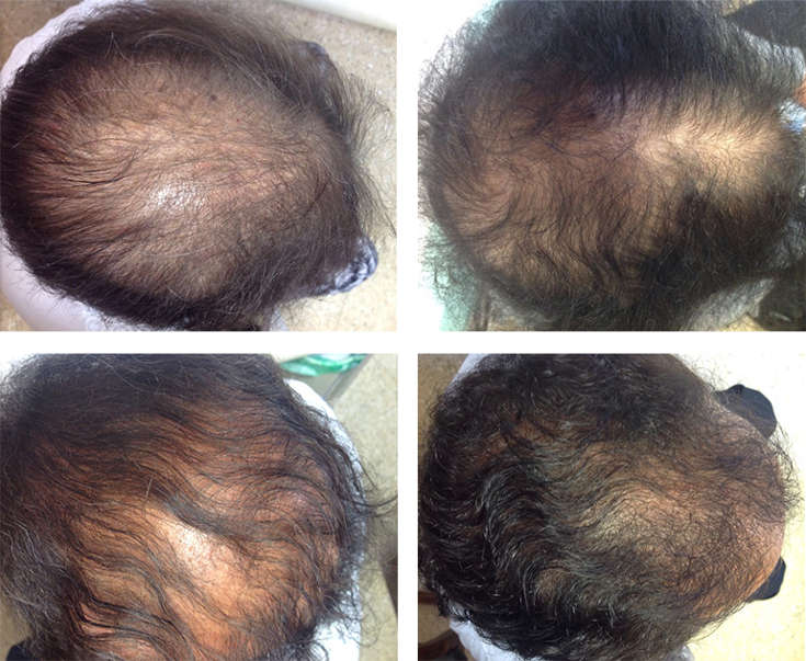 Hair Loss