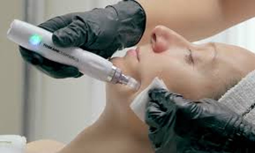 MICRO-NEEDLING