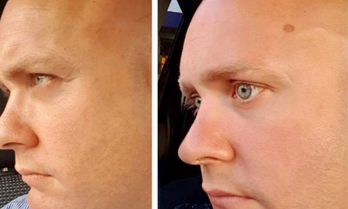 CRYOPEN SKIN LESION CRYOTHERAPY
