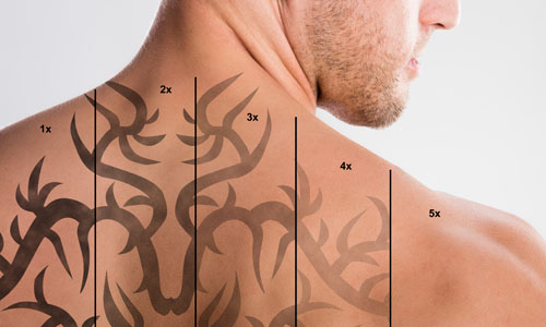 LASER TATTOO REMOVAL